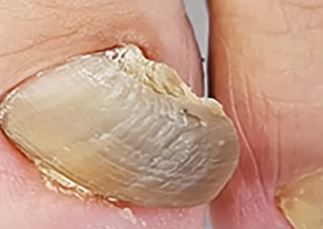 손 발톱 무좀 가장 확실한 치료 방법 4가지