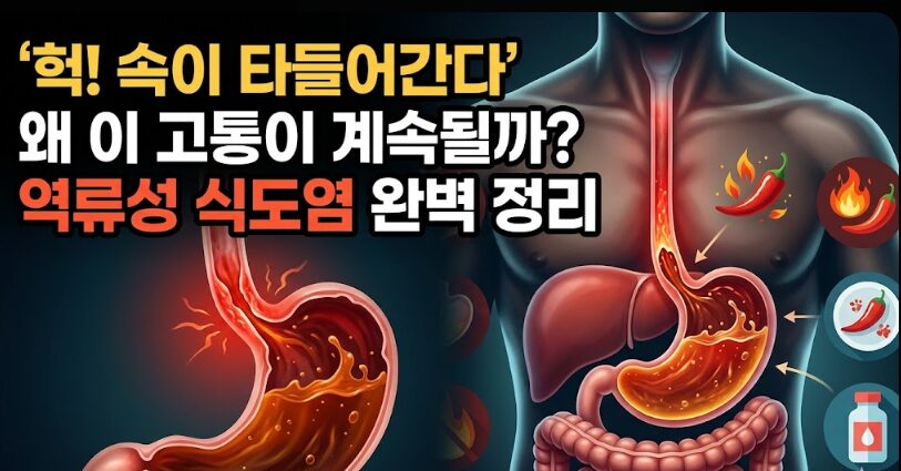 역류성 식도염 증상·원인·치료법 완벽 가이드 — 속쓰림부터 바렛 식도까지
