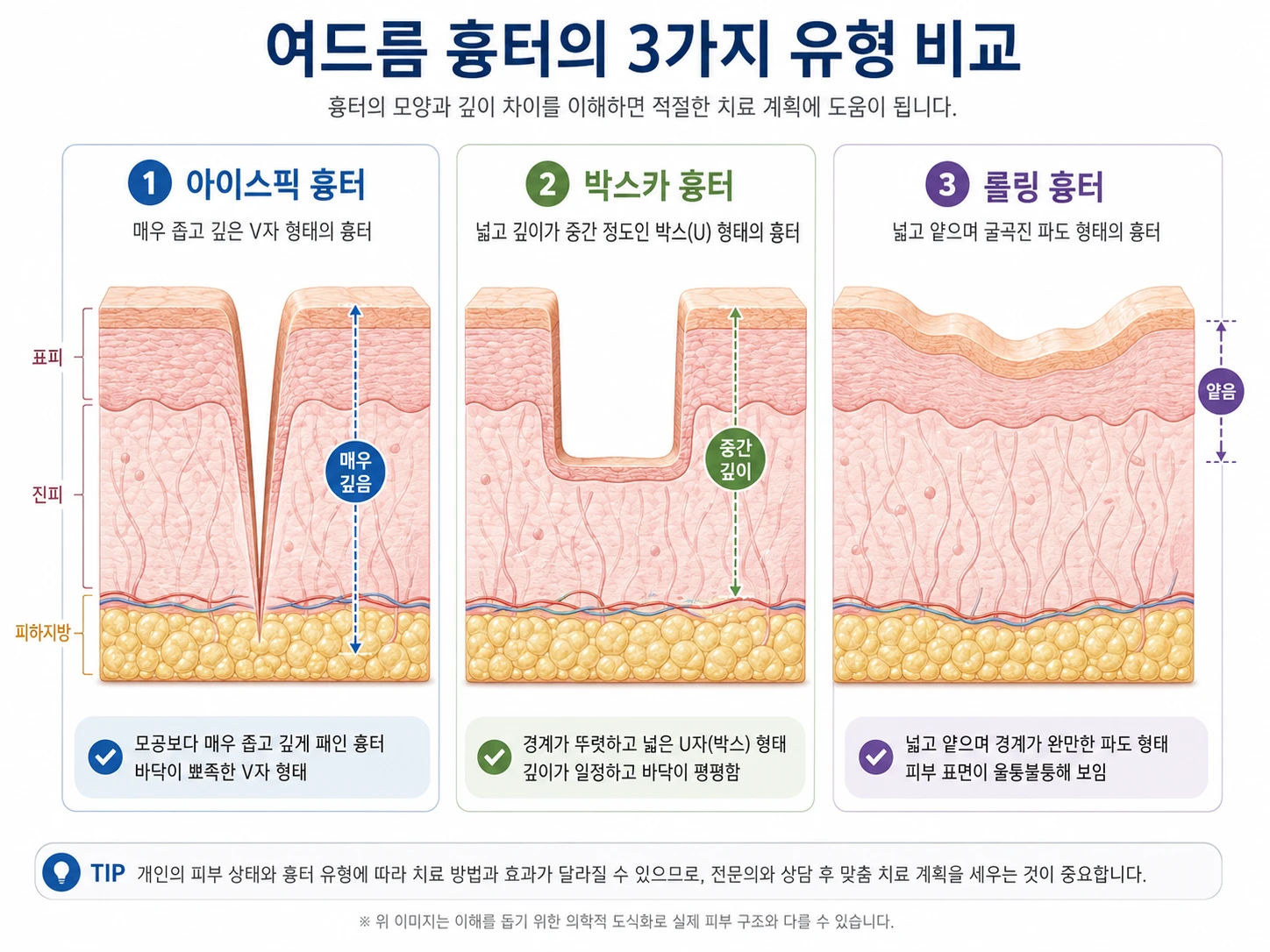 아이스픽·박스카·롤링 여드름 흉터 3가지의 피부 단면도 비교 인포그래픽