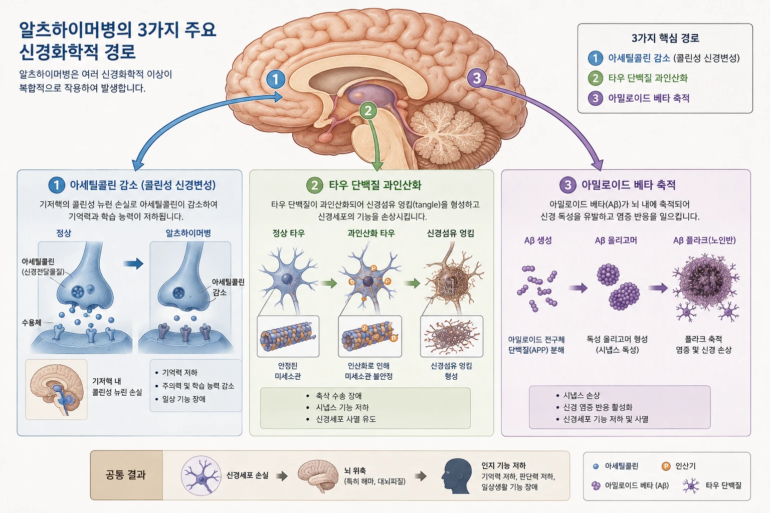 알츠하이머병의 3가지 주요 신경화학 경로 인포그래픽 — 아세틸콜린 감소, 타우 단백질 과인산화, 아밀로이드베타 축적 메커니즘 도해