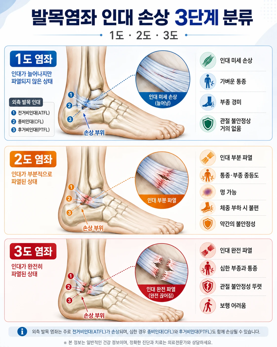 발목염좌 인대 손상 1도·2도·3도 3단계 분류 의학 인포그래픽