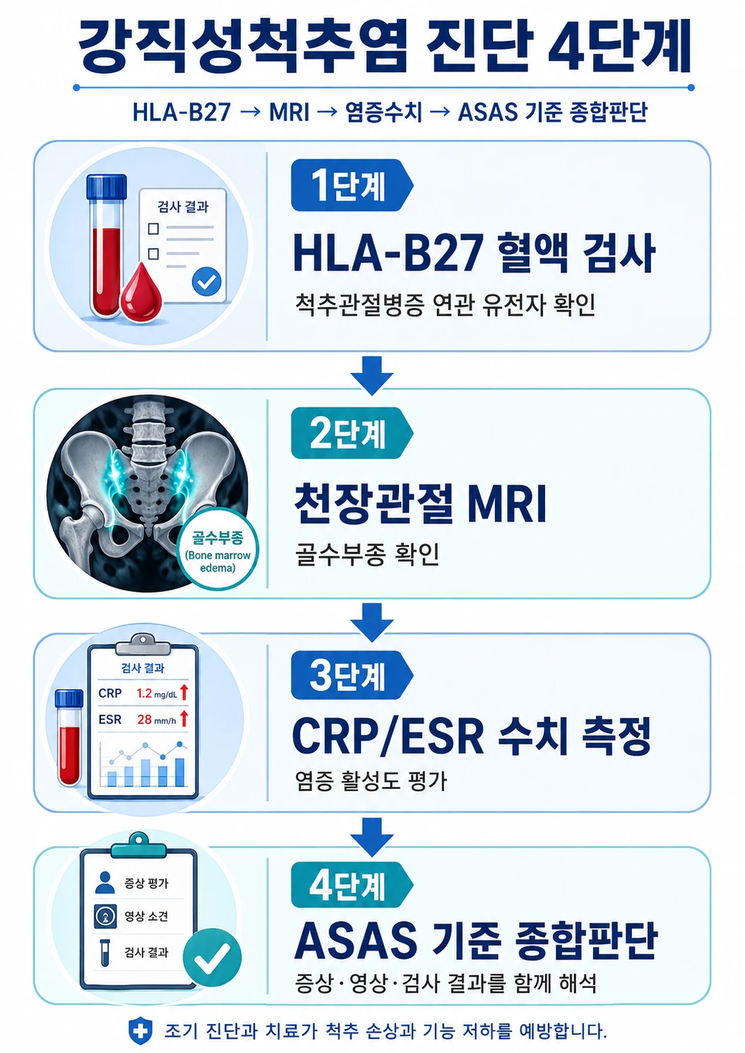 강직성척추염 진단 4단계 — HLA-B27 혈액 검사, 천장관절 MRI 골수부종 확인, CRP/ESR 수치 측정, ASAS 기준 종합판단 흐름을 보여주는 인포그래픽