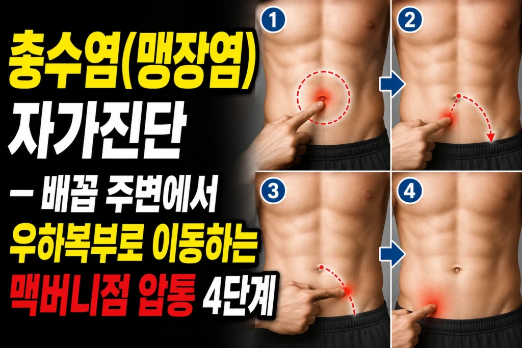 충수염(맹장염) 자가진단 — 배꼽 주변에서 우하복부로 이동하는 맥버니점 압통 4단계