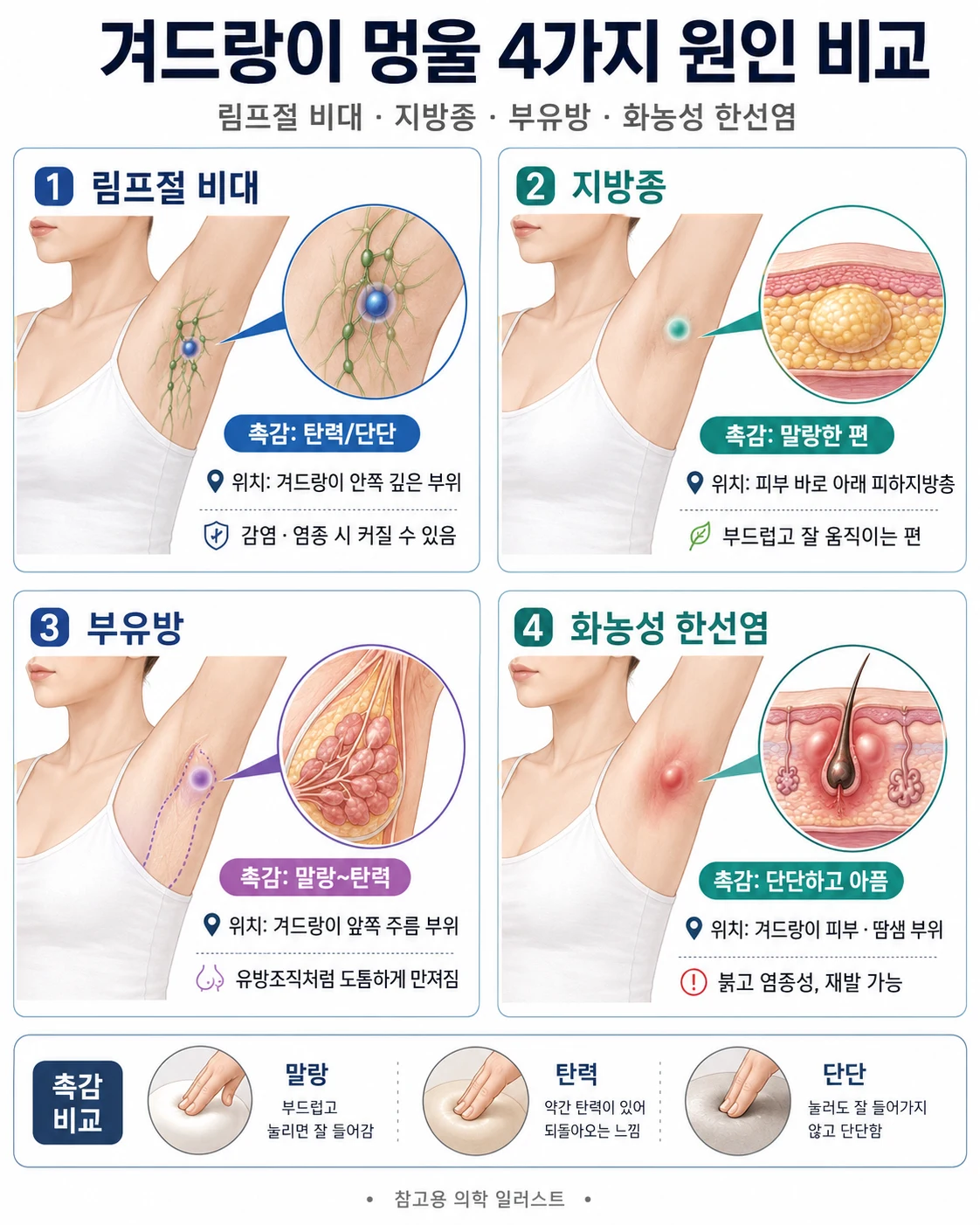 겨드랑이 멍울의 4가지 원인(림프절 비대, 지방종, 부유방, 화농성 한선염)을 촉감과 위치로 비교한 의학 인포그래픽