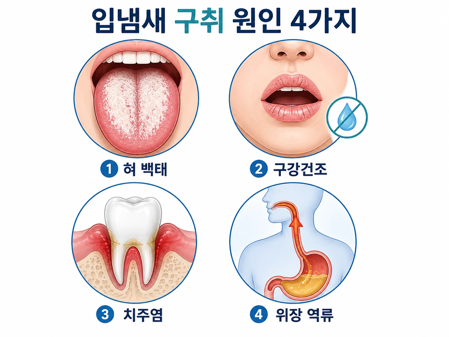 입냄새(구취) 원인 4가지를 한글로 도식화한 인포그래픽: ①혀 백태(설태) ②구강건조증 ③치주염 ④위장 역류성식도염