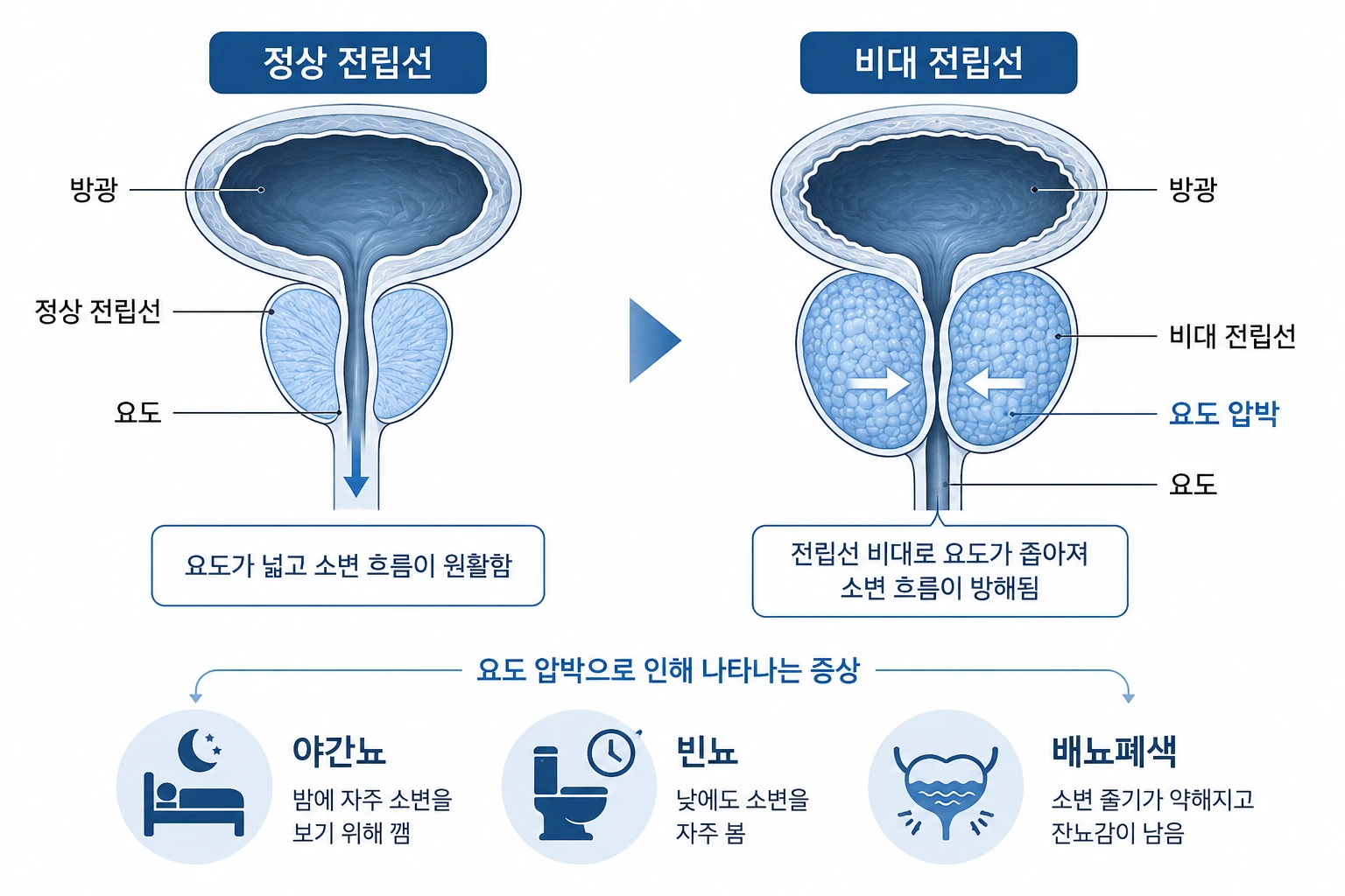 정상 전립선과 비대해진 전립선이 요도를 압박해 야간뇨·빈뇨·배뇨폐색을 일으키는 원리를 비교한 의학 단면 일러스트
