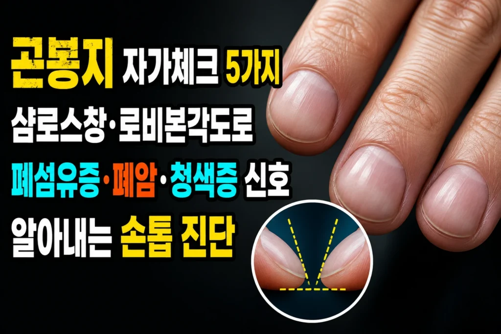 곤봉지(clubbing) 자가체크 5가지 — 샴로스창·로비본각도로 폐섬유증·폐암·청색증 신호 알아내는 손톱 진단