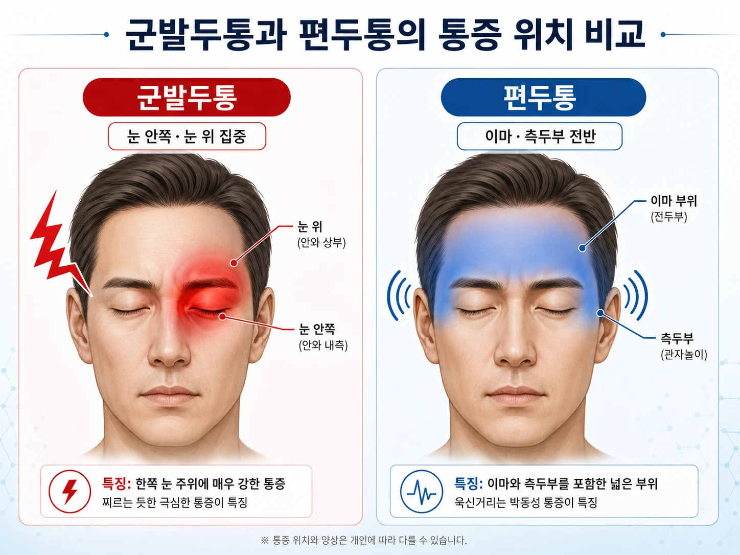 군발두통은 한쪽 눈 안쪽·눈 위에 집중되고 편두통은 이마와 측두부 전반에 퍼지는 통증 위치 비교 인포그래픽