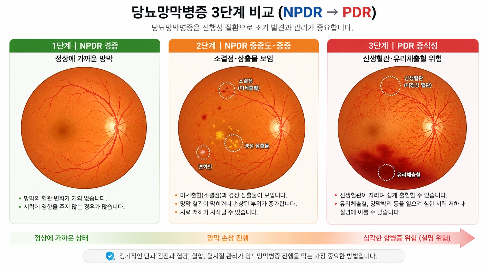당뇨망막병증 NPDR 경증(정상에 가까운 망막), NPDR 중등도·중증(소결점·삼출물), PDR 증식성(신생혈관·유리체출혈 위험) 3단계 안저 비교 인포그래픽