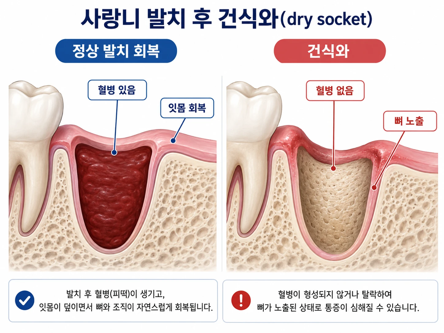 사랑니 발치 후 정상 회복(혈병 있음, 잇몸 회복)과 건식와(혈병 없음, 뼈 노출)를 나란히 비교하는 의학 단면 일러스트