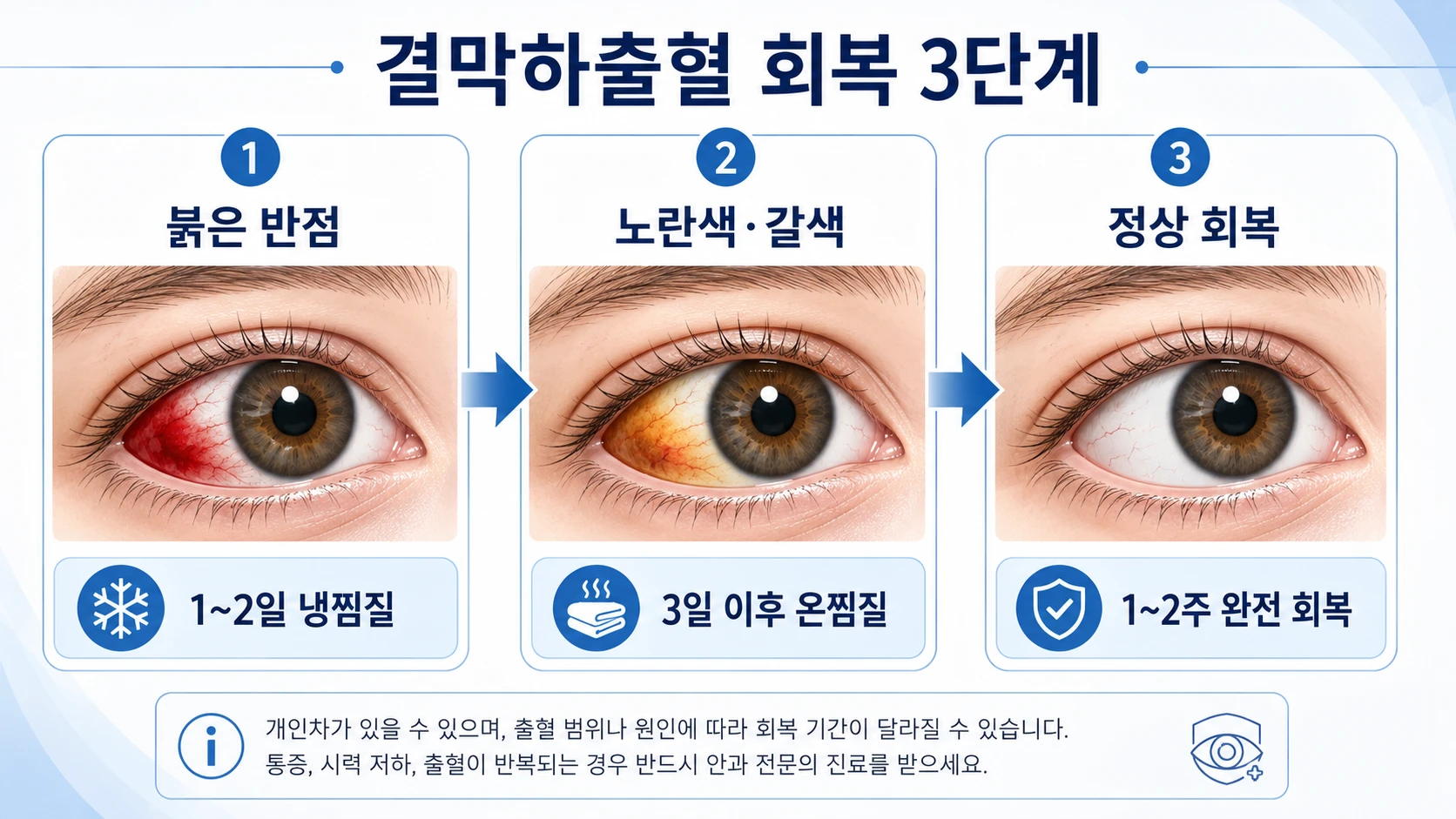 결막하출혈(눈 실핏줄 터짐) 회복 3단계 — 붉은 반점에서 노란색·갈색으로, 최종 정상 회복까지 단계별 증상 변화와 냉찜질·온찜질 관리법을 설명한 인포그래픽