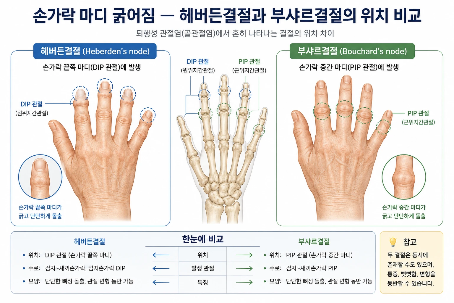 손가락 마디 굵어짐의 원인인 헤버든결절(DIP 관절)과 부샤르결절(PIP 관절)의 발생 위치를 비교하는 의학 일러스트