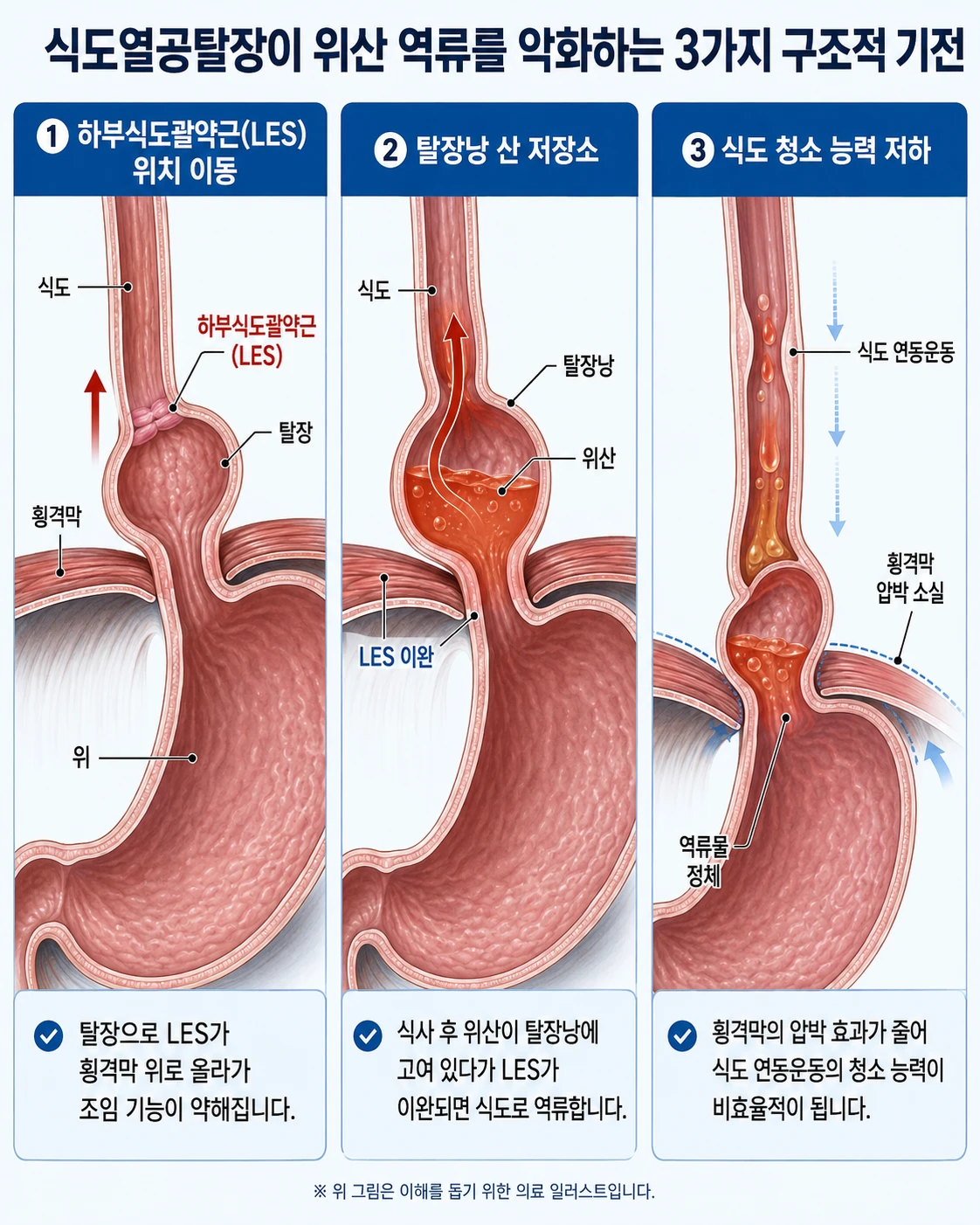 식도열공탈장이 위산 역류를 악화하는 3가지 구조적 기전(하부식도괄약근 위치 이동, 탈장낭 산 저장소, 식도 청소 능력 저하)을 보여주는 의학 인포그래픽