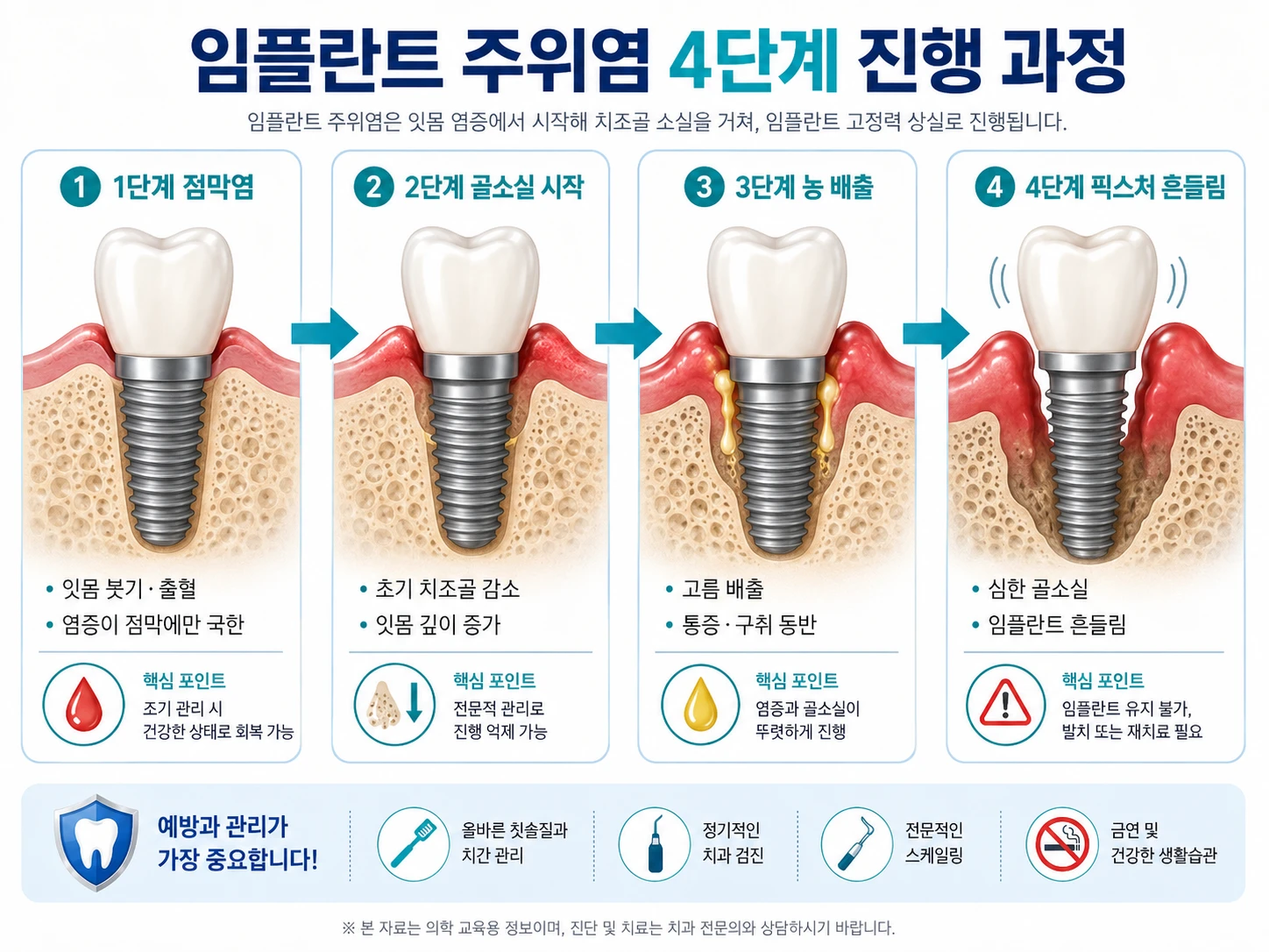 임플란트 주위염 4단계 진행 과정 — 점막염에서 골소실·농 배출·픽스처 흔들림까지 단계별 의학 일러스트