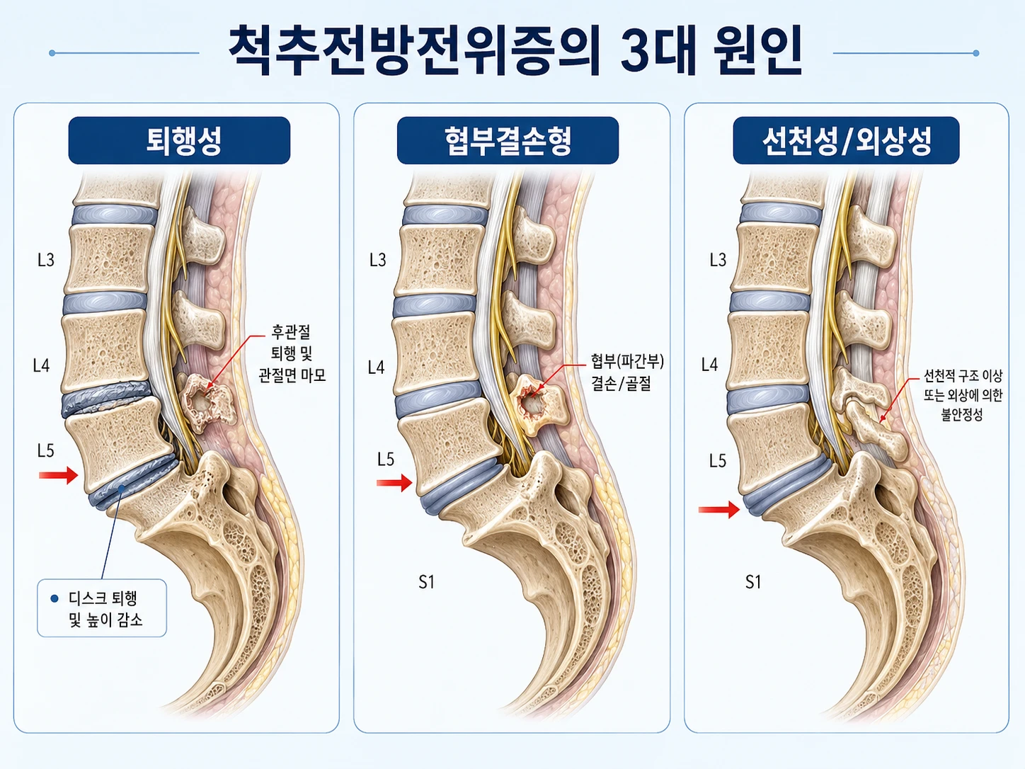 요추전방전위증의 퇴행성·협부결손형·선천성 3가지 발생 원인을 척추 단면 일러스트로 비교한 인포그래픽