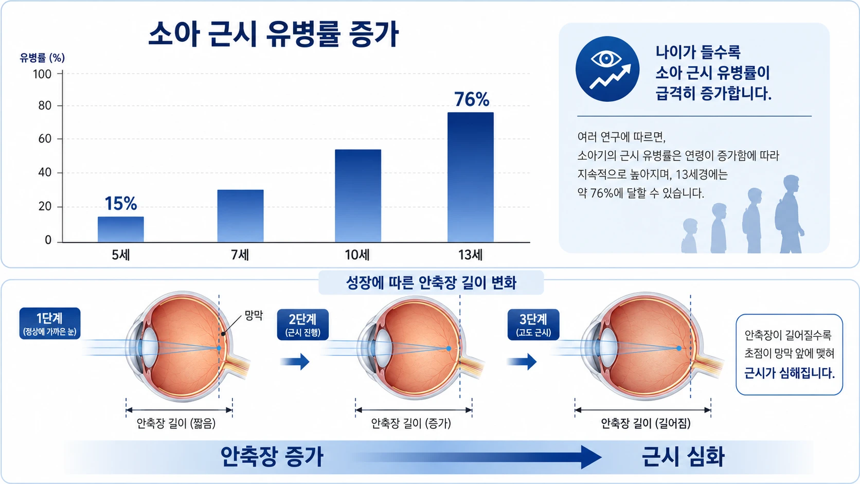 소아 근시 유병률이 만 5세 15%에서 13세 76%로 증가하는 막대그래프와 안축장 성장에 따른 근시 심화 과정 인포그래픽