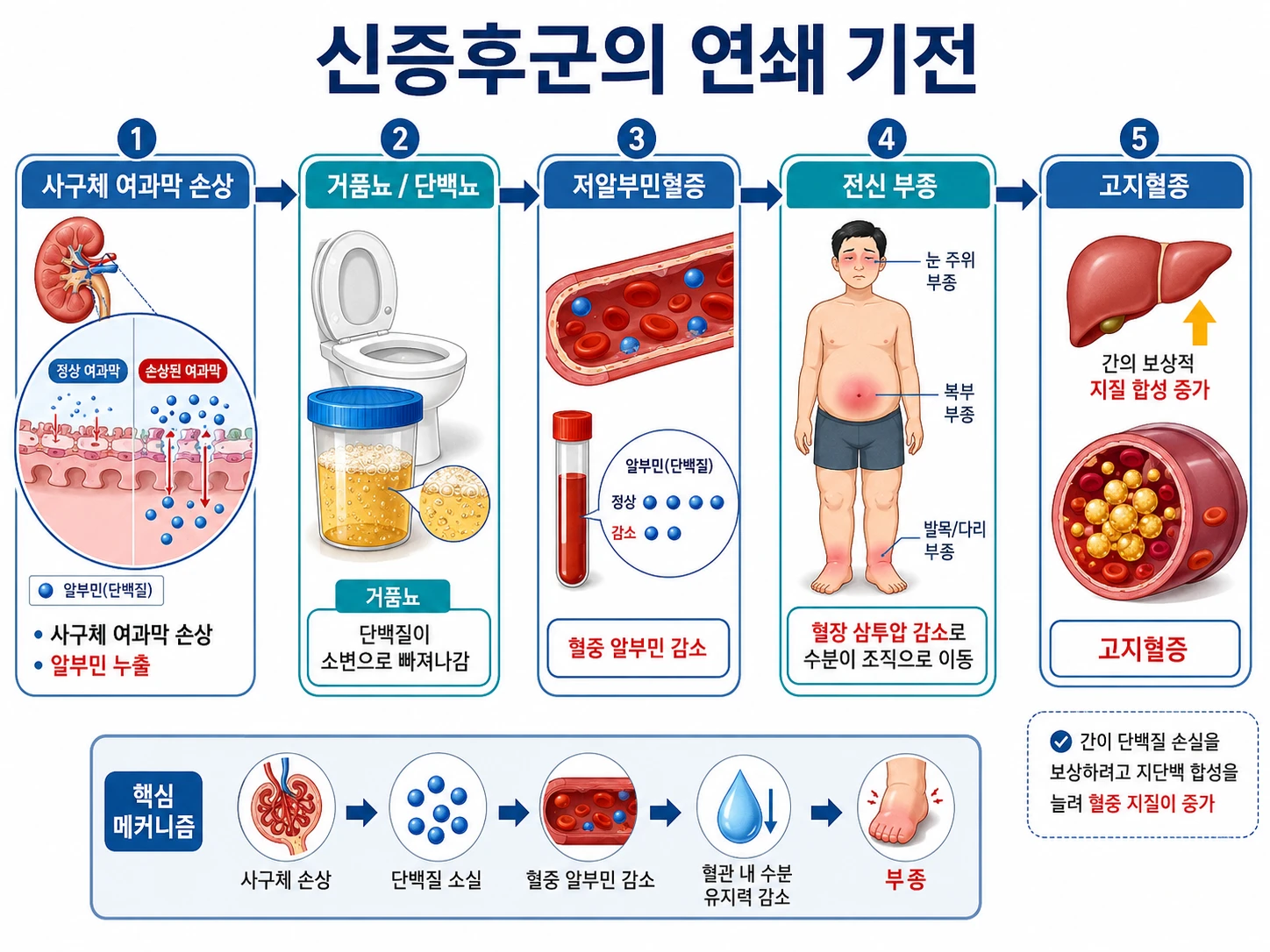 신증후군의 연쇄 기전 5단계 인포그래픽 — 사구체 여과막 손상·거품뇨·저알부민혈증·전신 부종·고지혈증
