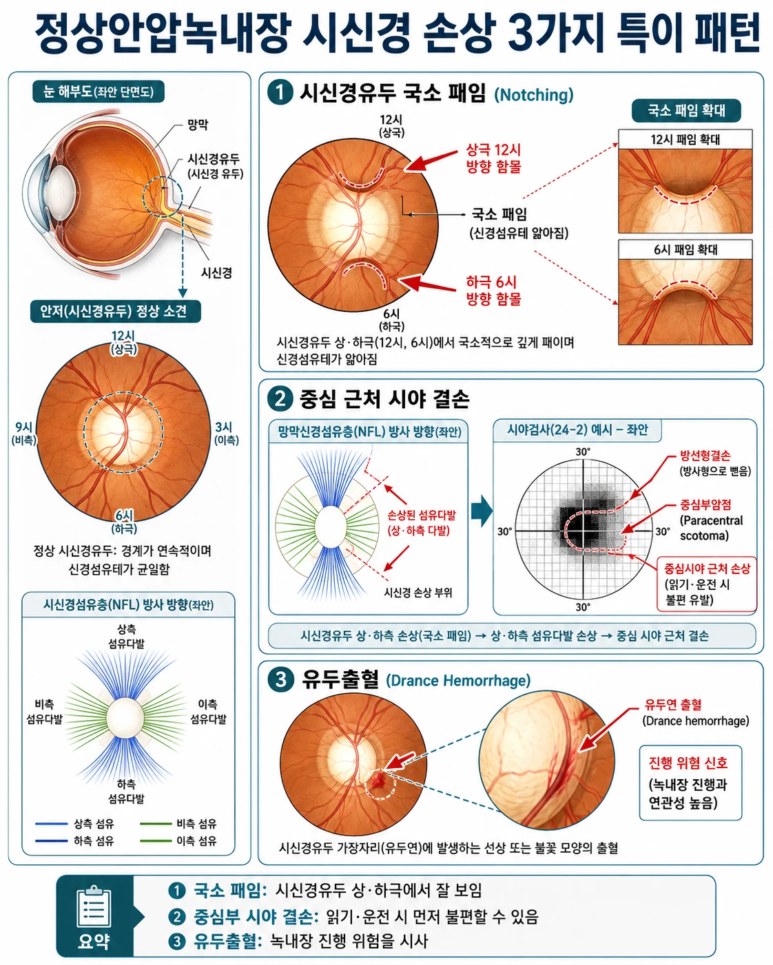 정상안압녹내장 시신경 손상 3가지 특이 패턴 인포그래픽