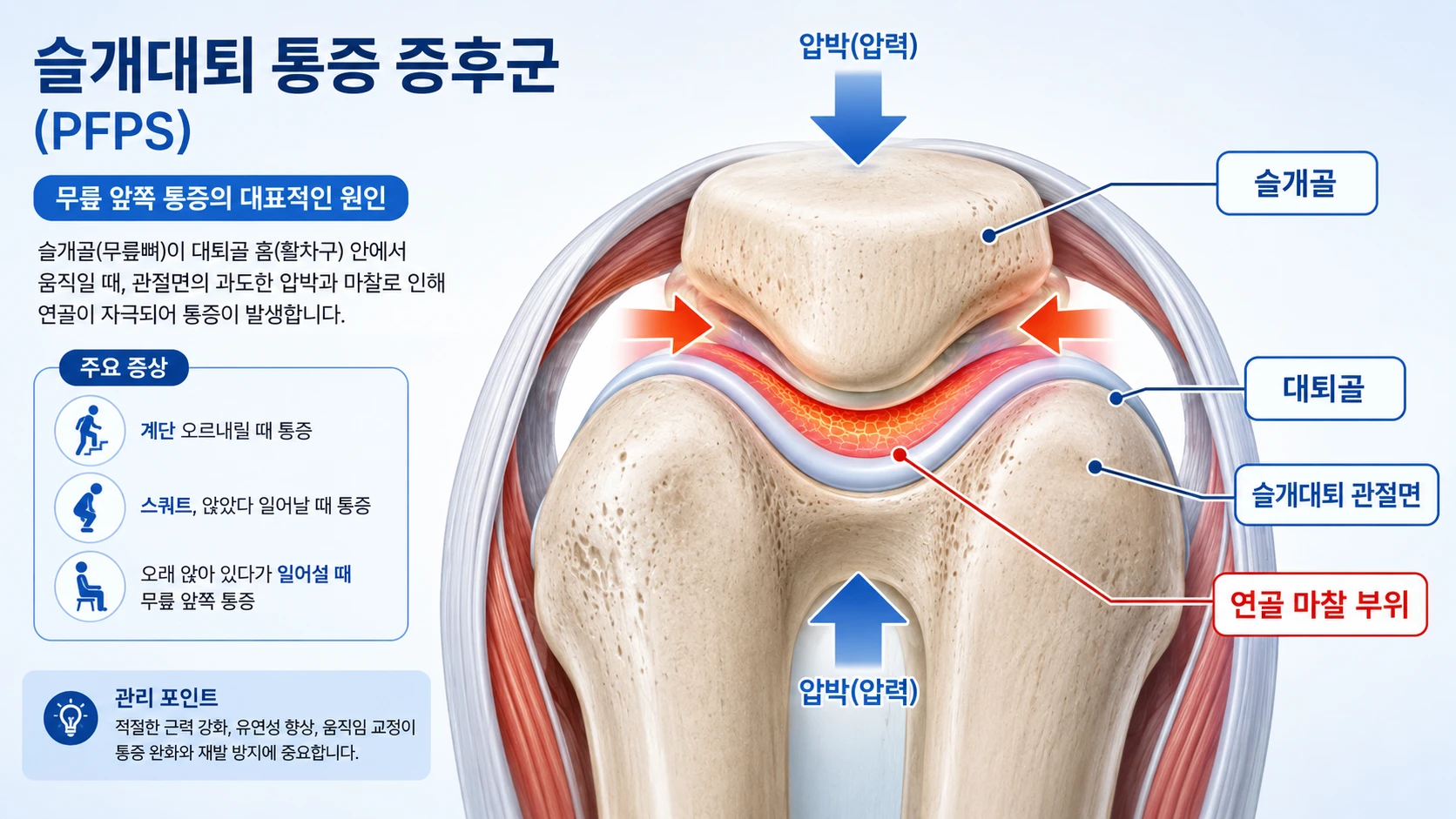 슬개골과 대퇴골 사이의 압박과 연골 마찰을 보여주는 슬개대퇴증후군 해부 인포그래픽