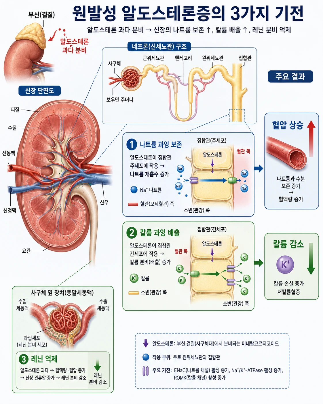 원발성 알도스테론증에서 알도스테론 과잉 분비가 나트륨 보존·칼륨 배출·레닌 억제를 유발하는 신장 단면도 인포그래픽