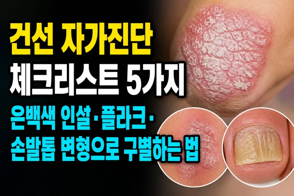 건선 자가진단 체크리스트 5가지 — 은백색 인설·플라크·손발톱 변형으로 구별하는 법