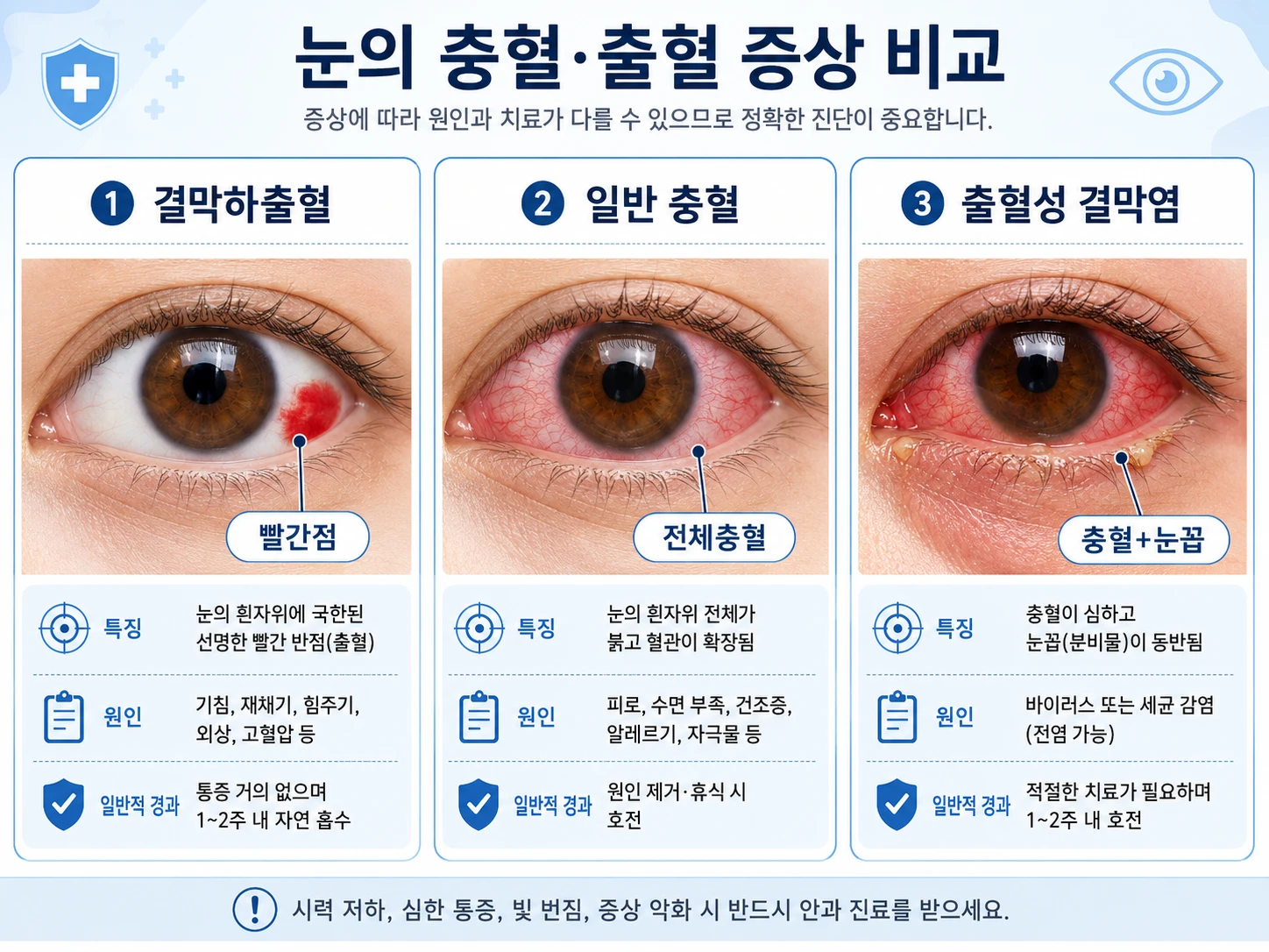 결막하출혈(빨간점), 일반 충혈(전체충혈), 출혈성 결막염(충혈+눈꼽)의 눈 상태를 3단 비교한 의학 일러스트