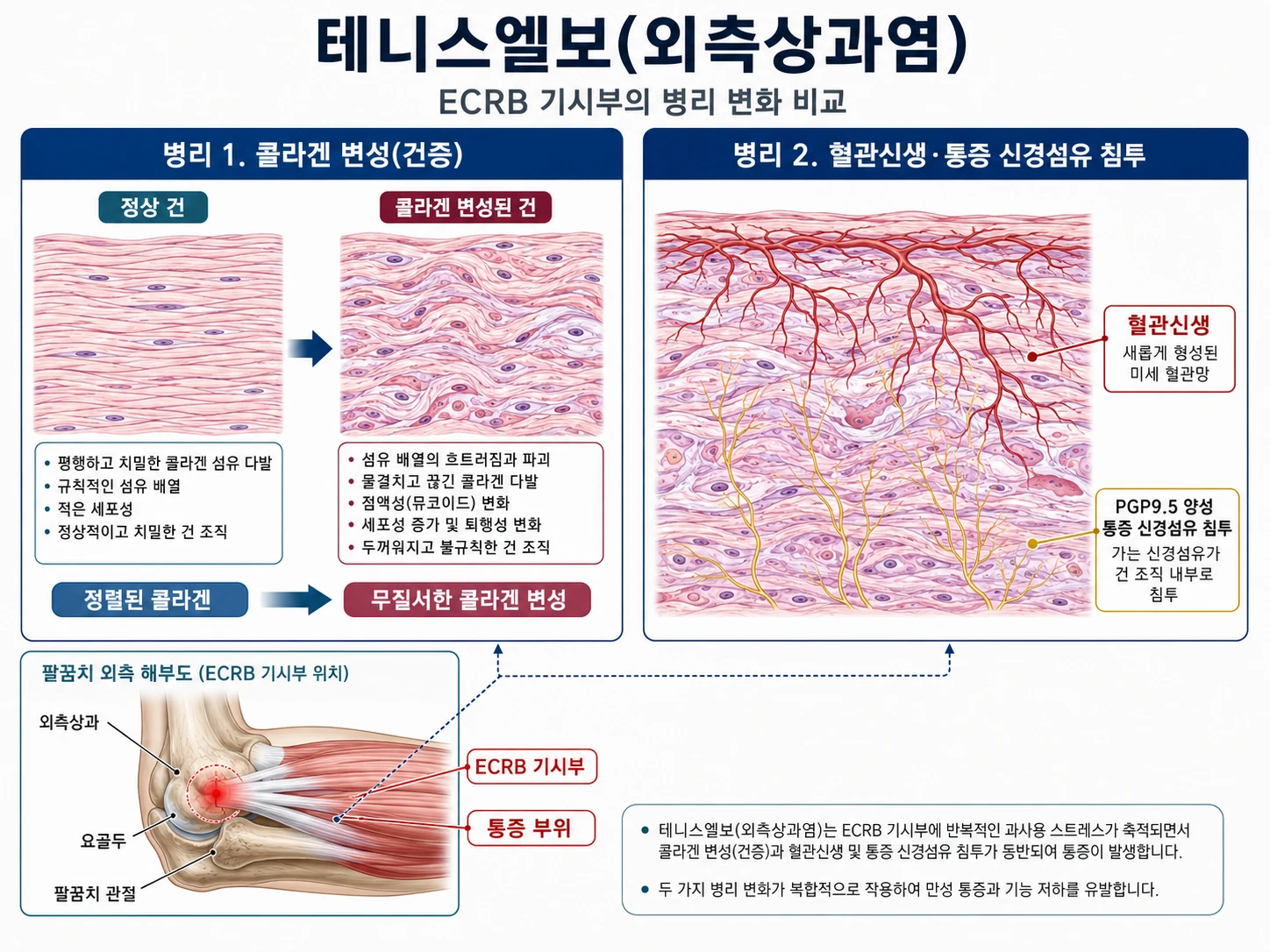 단요측수근신근(ECRB) 기시부의 콜라겐 변성(건증)과 혈관신생·통증 신경섬유 침투를 나란히 비교한 테니스엘보 의학 인포그래픽