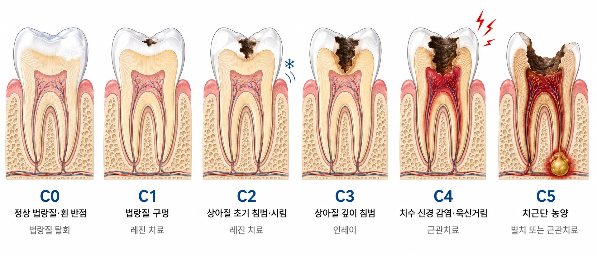 충치 C0부터 C5까지 6단계 치아 단면 그림으로 법랑질 탈회, 레진, 상아질 침범, 근관치료, 발치 치료 과정을 한눈에 비교