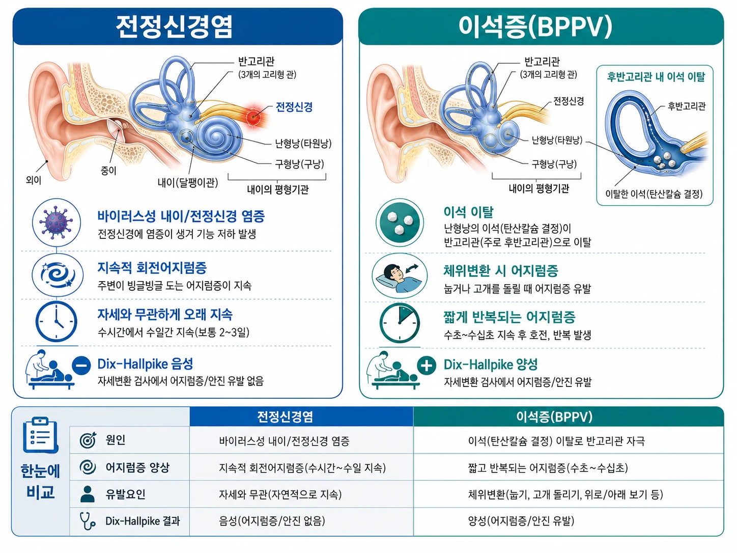 전정신경염과 이석증(BPPV)의 원인, 어지럼증 양상, Dix-Hallpike 검사 결과를 내이 해부도와 함께 좌우로 비교한 의학 인포그래픽