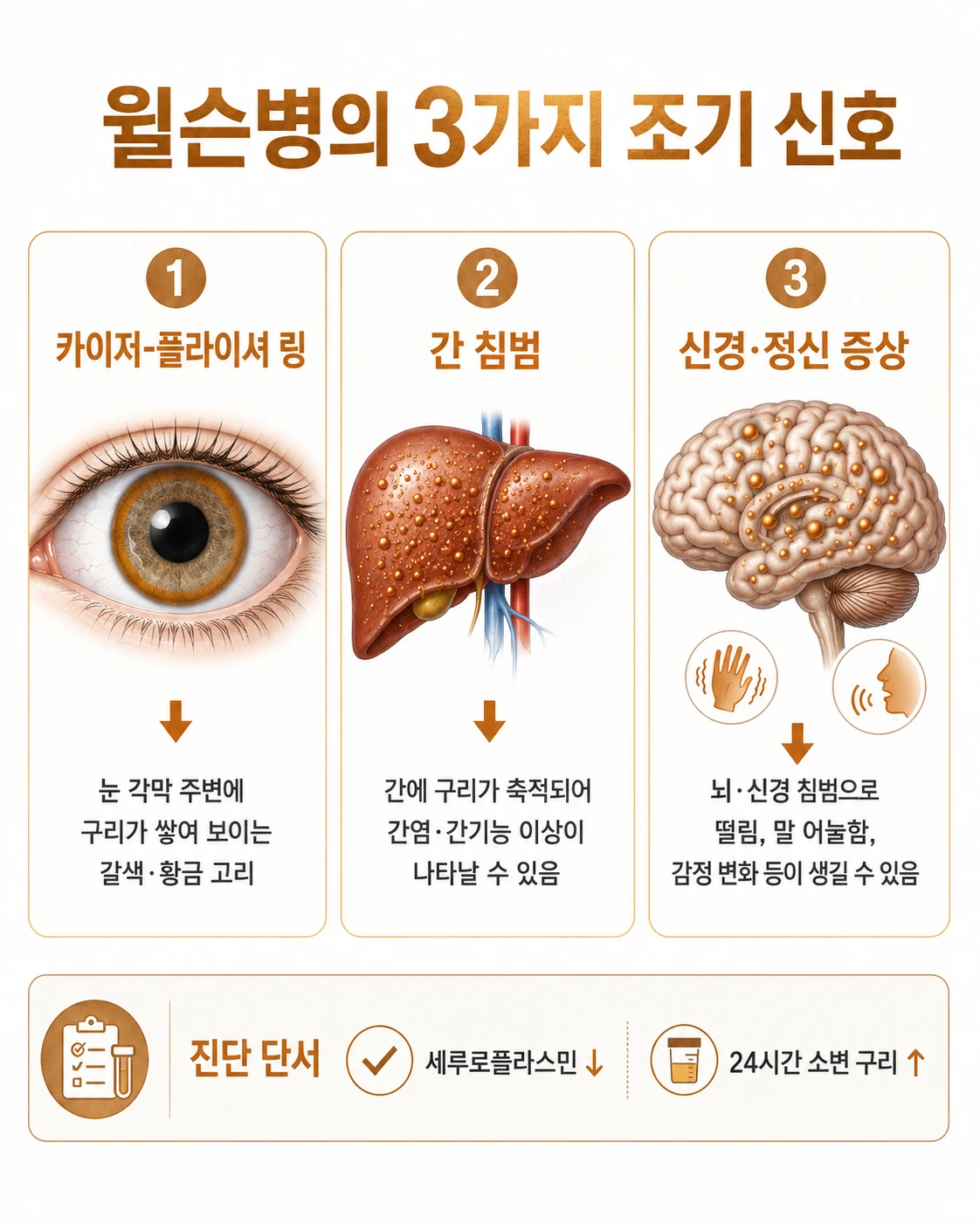 윌슨병 증상 인포그래픽: 카이저-플라이셔 링(눈 각막 구리 침착), 간 침범(간 손상), 신경·정신 증상(뇌·신경 침범) 3가지 조기 신호와 진단 단서(세룰로플라스민 저하·소변 구리 상승)